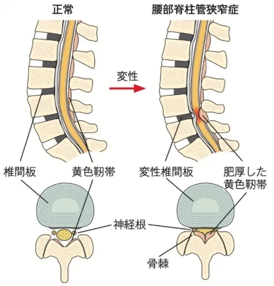 【身体構造力シリーズ】 第7回：脊柱管狭窄症 